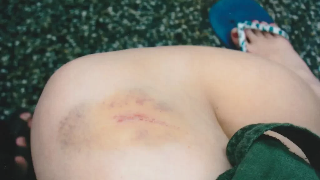 A graze and yellow bruise on a womans leg